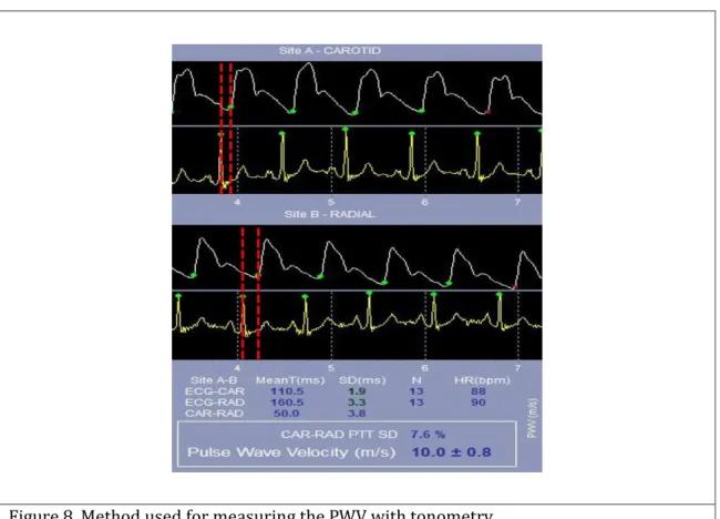 Figure 8. Method used for measuring the PWV with tonometry. 
