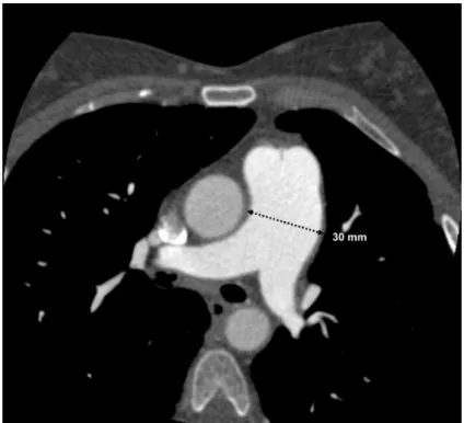 Fig. 2 - Angiografia computorizada torácica. Objectivação do diâmetro da AP principal em 30mm