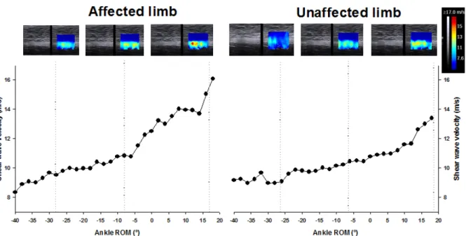 Figure 10. Sciatic shear wave velocity response during an ankle dorsiflexion, in both the affected (left  image) and unaffected (right image) limbs of one participant (#7) with low back related leg pain