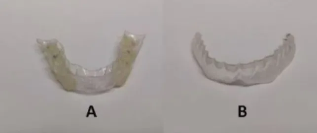 Figure 4. Oral devices tested. A -  Occlusal splint; B -  Placebo splint 