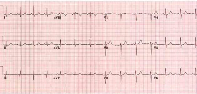 Figura 5 – Electrocardiograma normal. 