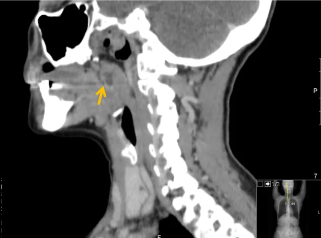 Figura 7 – Tomografia computorizada cervico-toraco-abdomino-pélvica. Observa-se  pequena área hipodensa, centrada à amígdala palatina direita (9x5 mm) (seta amarela)