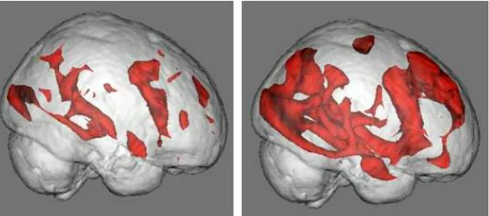 Figura 6: atividade cerebral (em vermelho), UCLA (2008) 