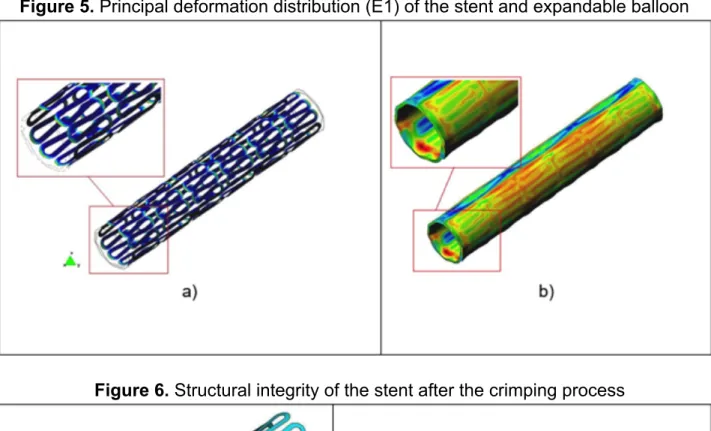 Figure 5. Principal deformation distribution (E1) of the stent and expandable balloon 