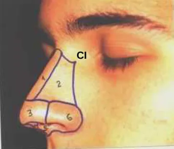 Fig. 16. - Subunidades estéticas do nariz: 1) dorso, 2) parede lateral, 3) ponta, 4) triângulo mole, 5)  columela e 6) asa