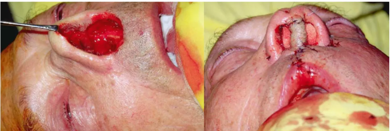 Fig 35 - 1) Defeito após exérese de CBC da columela. 2) Reconstrução com retalho labial e enxerto de cartilagem