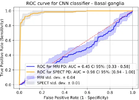 Figure 4.6 ROC curve and AUC for PD in basal ganglia classification of Control vs PD. 