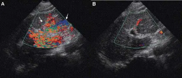 Fig 2 - Flash artifact. (A) Longitudinal CDUS through the left lobe of the liver  with flash artifact,  produced by respiratory motion