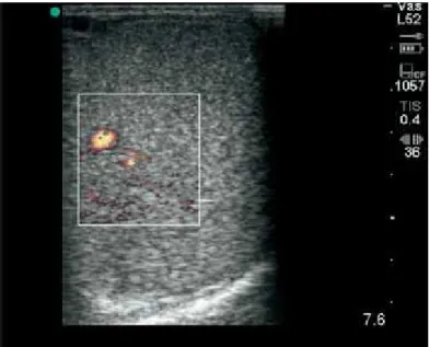 Fig 4 - Power Doppler ultrasound image of central vein and small intratesticular vessels 