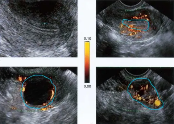 Fig  5  -  Ultrasound  colour  power  Doppler  images.  Top  left:  transvaginal  gray-scale  image  of  endometrium