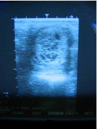 Fig 6 - Ultrasound of a CH few hours after ovulation;