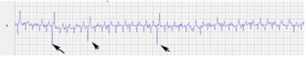 Fig  4  -  Exercise  ECG  recording,  the  black  arrows  represent  3  of  the  ventricular  premature  depolarizations recorded 
