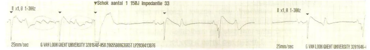 Fig 5 - Transvenous electrical cardioversion ECG recording of Case III: with the first shock sinus  rhythm was successfully restored