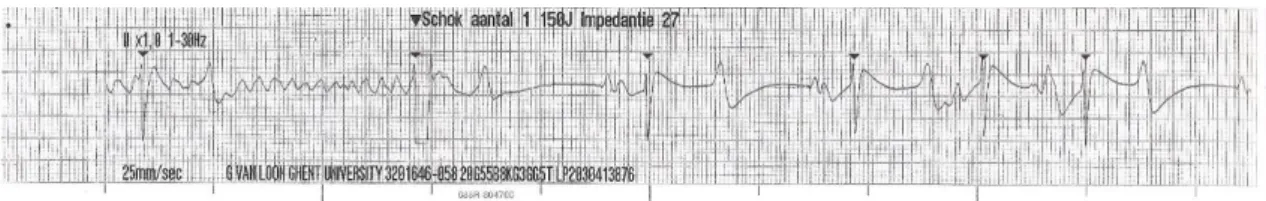 Fig  6  -  Transvenous  electrical  cardioversion  ECG  recording  of  Case  V:  with  the  first  shock sinus rhythm was successfully restored 