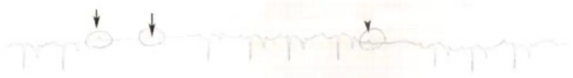 Fig 9 - ECG recording at rest, the black arrows represent the Second AV blocks 