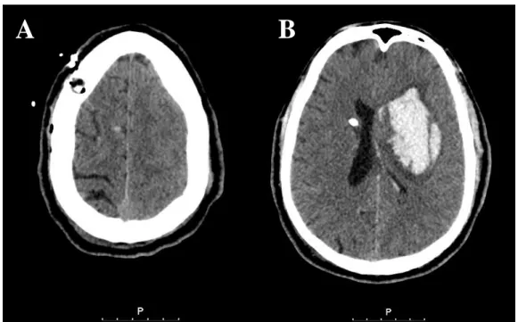 Figura  5  – Tomografia  Computorizada  Crânio-Encefálica  de reavaliação  onde se observa em  (A)  buraco  de  trépano  frontal  direito  com  cateter  de  derivação  ventricular  e  em  (B)  hematoma  núcleo -capsular  esquerdo