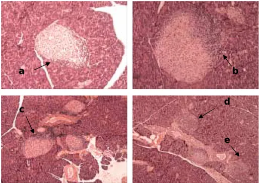Figura 10- Insulite. Diferentes graus de infiltração dos ilhéus de Langerhans  pancreáticos de murganhos fêmea NOD.Lt/J