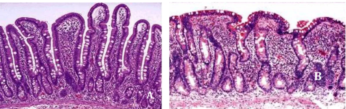 Figure   4.   Small   intestine   villus   (A-­‐   Normal;   B-­‐   Absence   of   villous   due   to   gluten   sensitivity)    (CeliAct