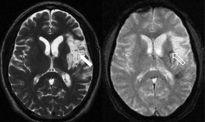 Figura 1- Imagens de ressonância magnética no plano axial (A - ponderada em T2 e B -   gradiente refocalizado eco) de um paciente masculino de 55 anos, onde se observa  uma  área de malácia secundária à isquemia  (seta)  com sinais de transformação  hemorr