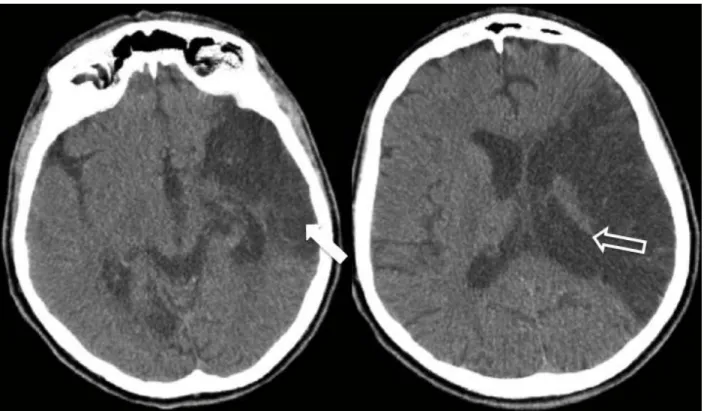 Figura 4  –  Imagens de tomografia computadorizada no plano axial, de paciente  masculino de 51 anos, com áreas de malácia (seta fechada) por isquemia no  território da ACM esquerda, com retração do ventrículo ipsilateral (seta aberta)