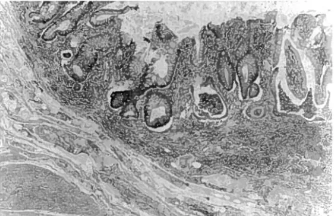 Fig. 6 - Distorção glândular; firmação de abcessos de cripta (H &amp; E.