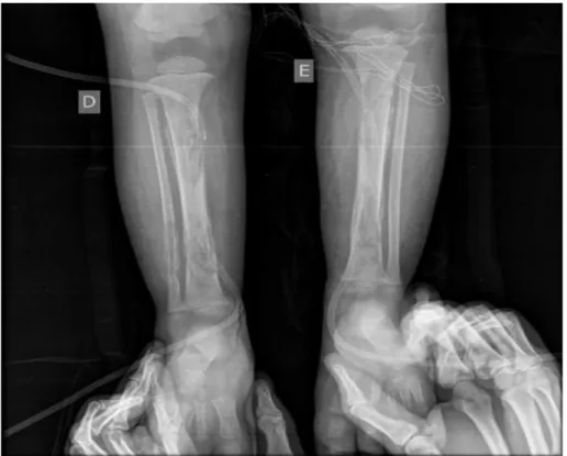 Figura  1.  Membros  inferiores  afetados  pela  osteomielite.  Região  tibial  bilateral  com  lesões  líticas e redução da densidade óssea