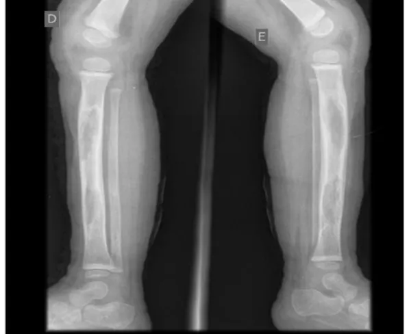 Figura 4. Ao final do tratamento na internação, melhora do padrão tibial bilateralmente com  aparente aumento da densidade óssea