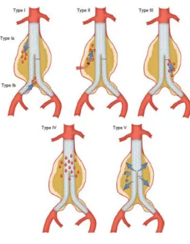 Figura 1. Tipos de endoleak 