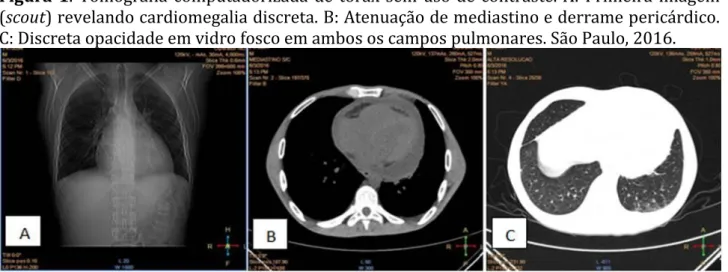 Figura  1.  Tomografia  computadorizada  de  tórax  sem  uso  de  contraste.  A:  Primeira  imagem  (scout) revelando cardiomegalia discreta