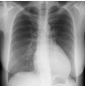 Figura 3 - Radiografia torácica de doente com anomalia de Ebstein e regurgitação tricúspide severa e defeito septal  interauricular, prévia a cirurgia de correcção tricúspide