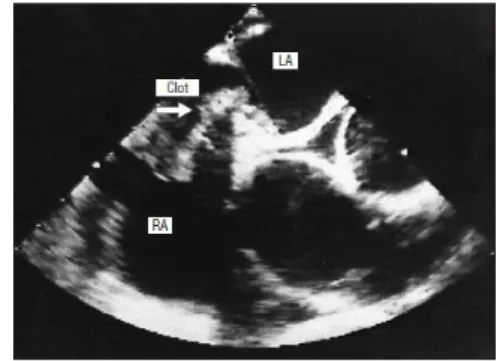Figura 5 - Ecocardiograma transesofágico de embolia paradoxal eminente. É visualizável um êmbolo a atravessar o  foramen ovale