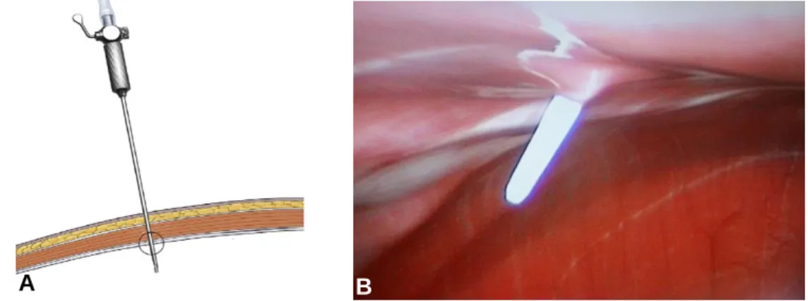 Figura  7  –  Posicionamento  correcto  da  agulha  de  Veress  (A)  Inserção  da  agulha  de  Veress  na  parede  abdominal  (adaptado  de  Rawlings,  2011);  (B)  Vista  laparoscópica  da  cavidade  peritoneal  (original da autora).