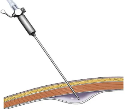 Figura 11 - Efeito cortina: falha na penetração do peritoneu (adaptado de Rawlings, 2011).