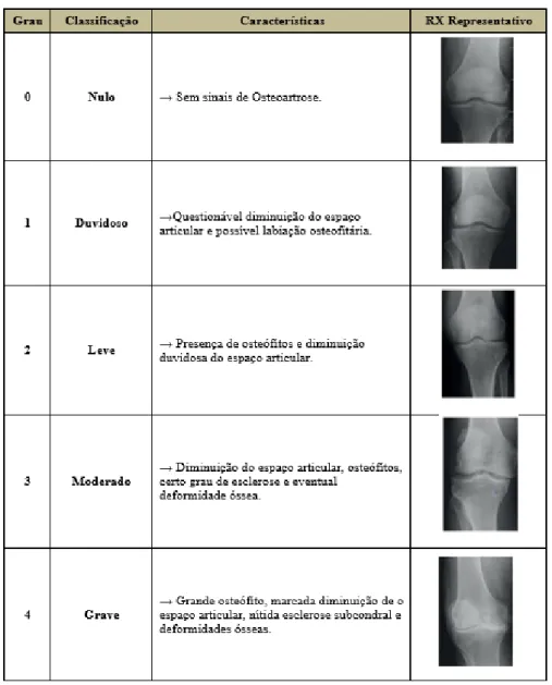 Tabela 4: Gradação da Osteoartrose (retirado de Kellgren-Lowrence, 1979) e Raio X representativo  segundo a classificação de Kellgren &amp; Lawrence (1957)