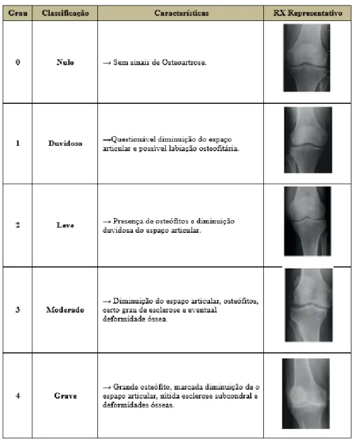 Tabela 4: Gradação da Osteoartrose (retirado de Kellgren-Lowrence, 1979) e Raio X representativo  segundo a classificação de Kellgren &amp; Lawrence (1957)