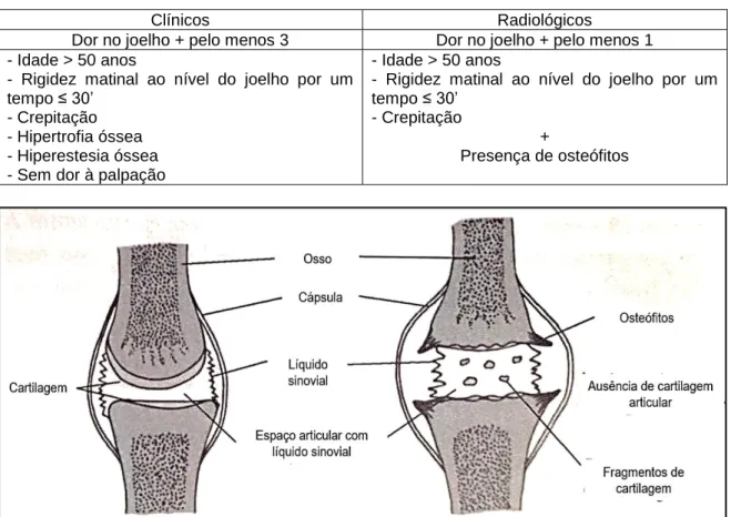 Figura 1. Articulação normal vs Articulação osteoartrósica (adaptado de Queiroz, 2011).