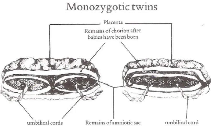 Figura 1: Placenta de gémeos monozigóticos 