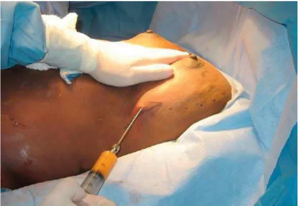 Fig. 5 – Injeção de gordura utilizando um padrão radial, numa cirurgia de aumento de volume