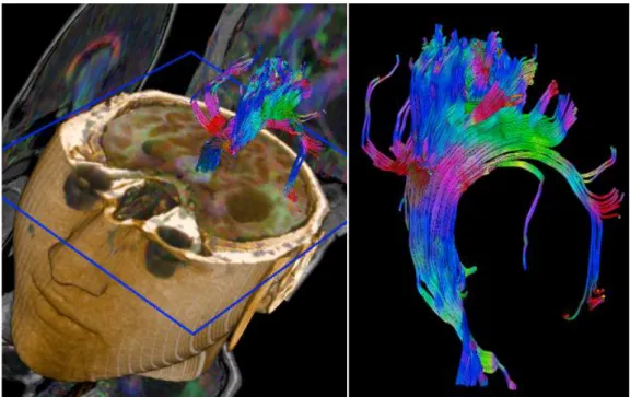 Figura 2.7 — Tratografia de um tumor quístico intra-axial supratentorial temporal esquerdo