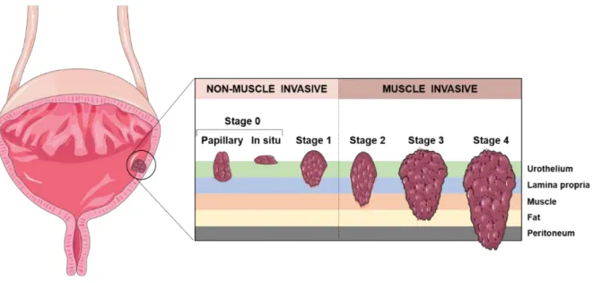 Figure 2. Staging of urothelial carcinoma. Bladder cancer stages are assigned on the basis of tumour invasion through the  layers of tissue that constitute the bladder