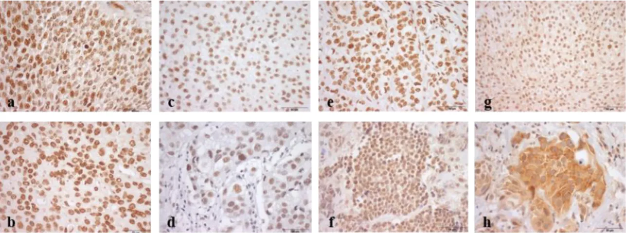 Figure  7.  Illustrative  images  of  immunostaining  for  m 6 A  (a),  METTL3  (b),  METTL14  (c),  VIRMA  (d);  WTAP  (e),  ALKBH5 (f), FTO (g) and YTHDF3 (h) in bladder cancer