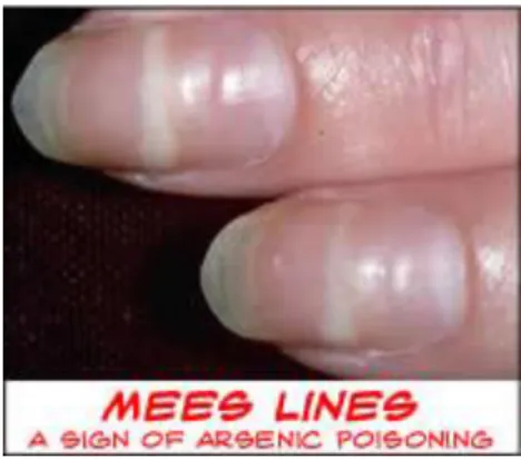 Figura 12 – “Aldrich – Mees”, manchas nas unhas provocadas pela intoxicação por arsénio (97)