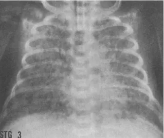 Figura  6  –  Peça  histológica  de  parênquima  pulmonar  de  RN  com  displasia  broncopulmonar