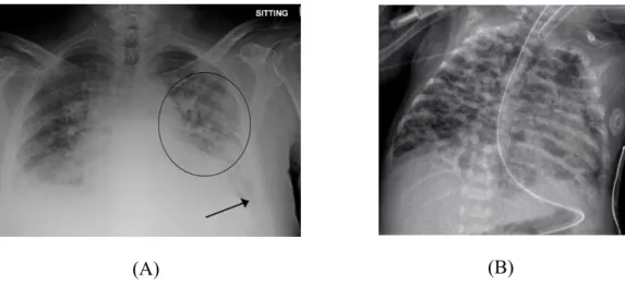 Figura 8 – Radiografia de recém-nascido com destaque para o edema (A) e para a inflamação (B) em árvore  brônquica decorrentes de ventilação mecânica