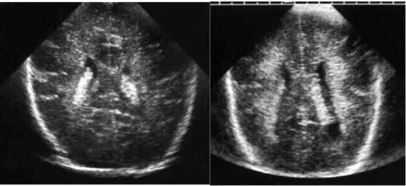 Figura 15 - Comparação de ultrassom transfontanelar com e sem leucomalácia periventricular