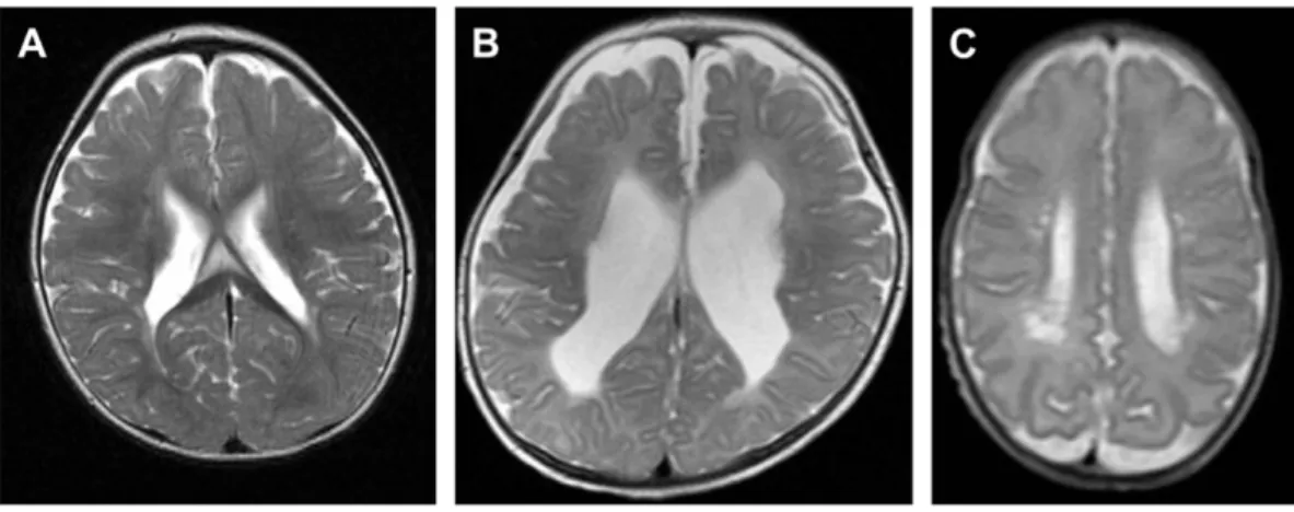 Figura 17 - Imagem de ressonância magnética de recém-nascido com LPV. Adaptado de Imamura et al  34