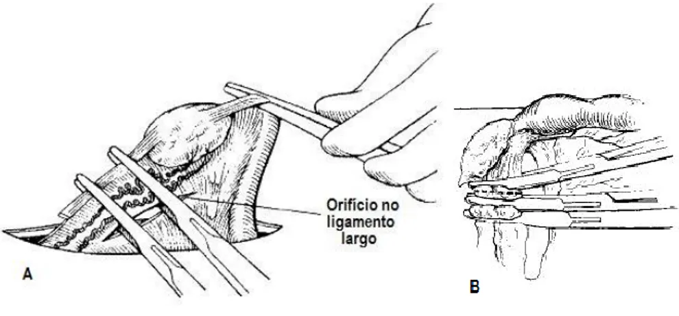 Figura 7 - A: Colocação das pinças de Rochester-Carmalt no pedículo ovárico e no ligamento  próprio  (adaptado  de  Fossum,  2008);  B:  Colocação  das  três  pinças  de  Rochester-Carmalt  no  pedículo ovárico (adaptado de Fingland, 1998)