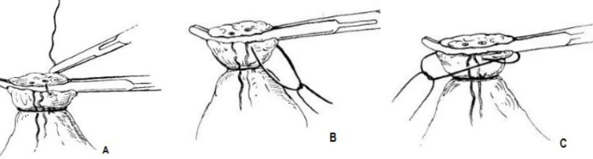 Figura  9  -  Colocar  uma  segunda  ligadura  ao  redor  do  pedículo,  próxima  à  primeira,  e  seccionar  o  pedículo  (adaptado  de  Fossum,  2008)