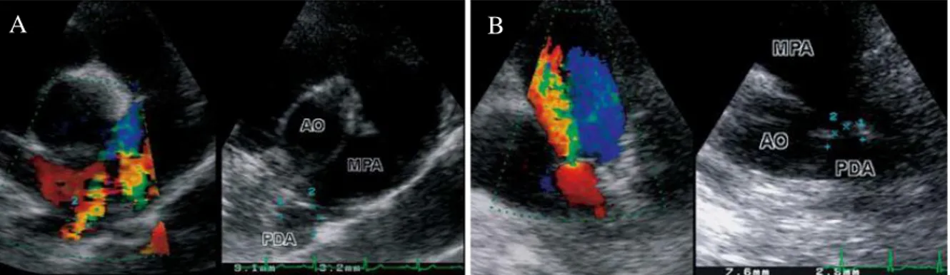 Figura 4 - Vista paraesternal direita (A) e vista paraesternal esquerda (B) de ecocardiografia  Doppler  e  ecocardiografia  bidimensional  de  uma  PCA  em  cão,  onde  (1)  indica  a  ampola  ductal e (2) indica o DMC (adaptado de Schneider et al., 2007)