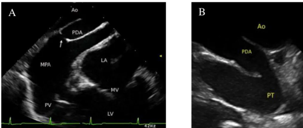 Figura 5 - Ecocardiografia  transesofágica  (A)  (adaptado  de  Porciello  et  al.,  2014)  e  ecocardiografia  intracardíaca  (B)  (adaptado  de  Chetboul  et  al.,  2017)  de  PCA